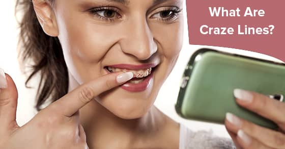 What are Craze Lines and are They a Dental Emergency?