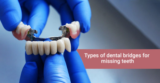 4 Types Of Dental Bridges For Missing Teeth Oakville Place Dental